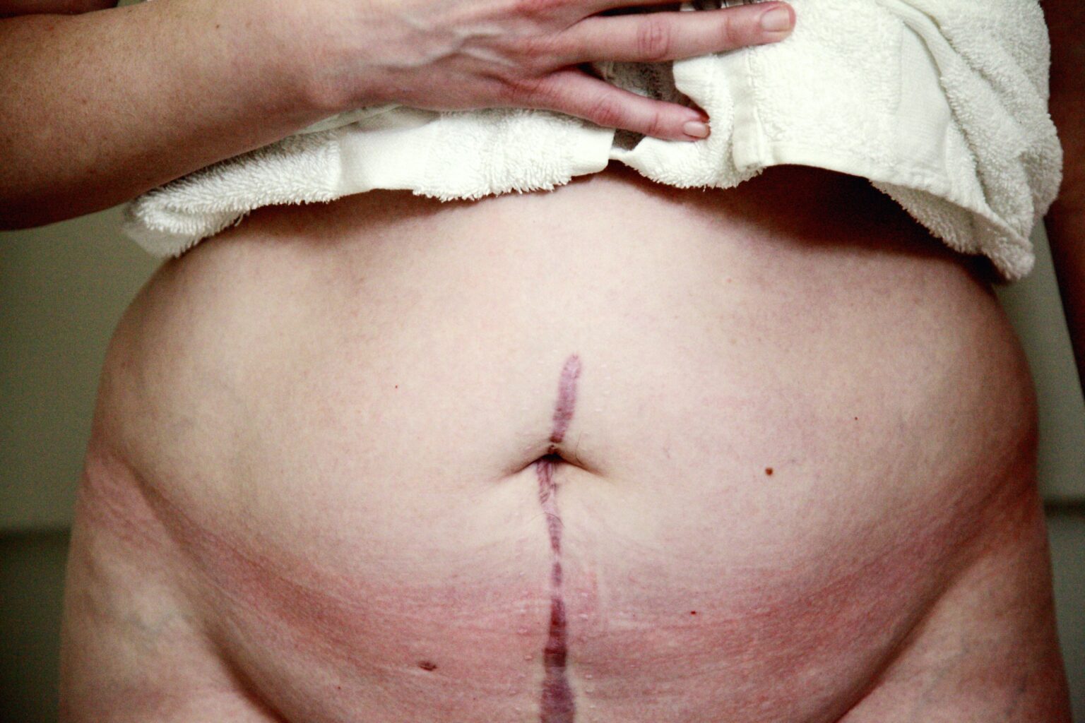 Recovering from a C-Section: Heartfelt Tips for Moms