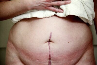 Recovering from a C-Section: Heartfelt Tips for Moms